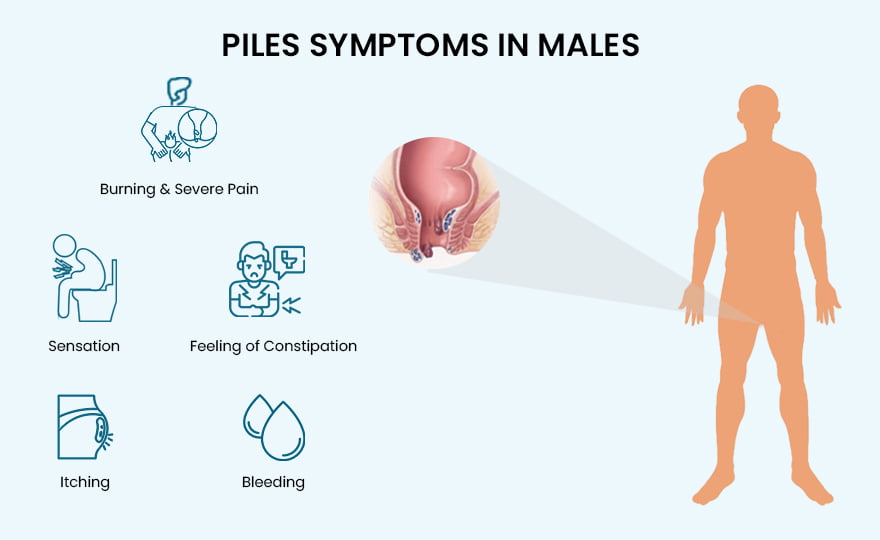 What are the main symptoms of Piles 8 Main symptoms Gastro Clinic