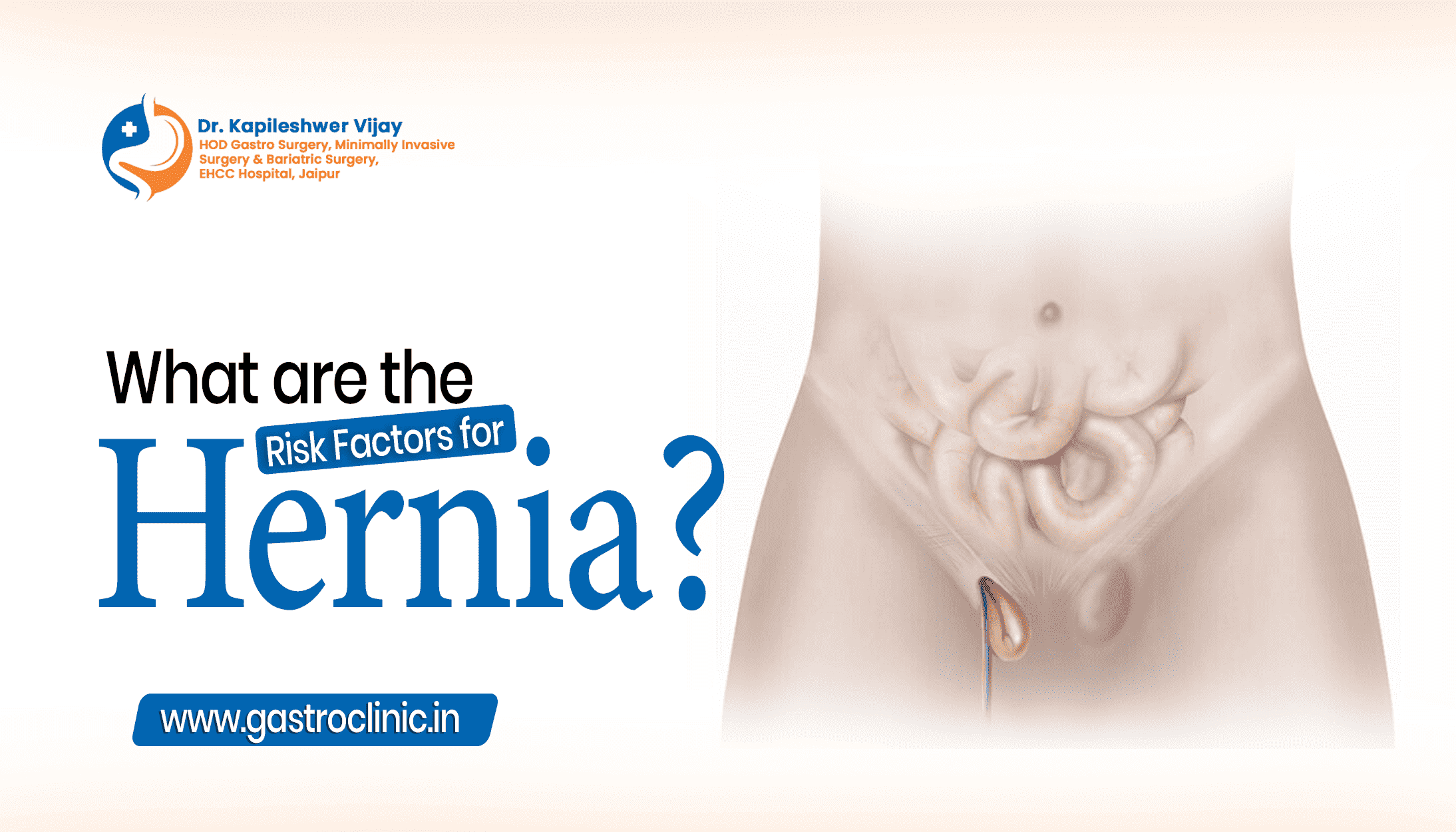 What are the Risk Factors for Hernia?