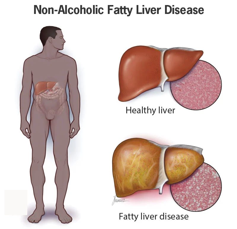 Fatty Liver Treatment in Jaipur By Dr. Kapileshwer Vijay Gastro Clinic