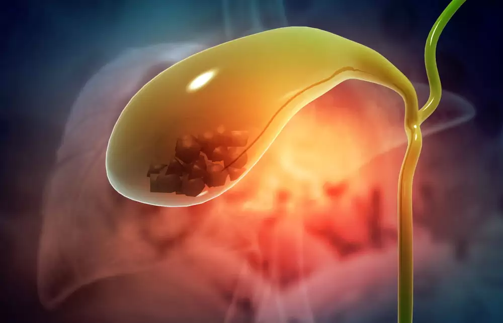 gall bladder stone surgery