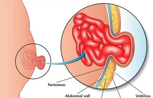 What is Hernia Surgery?