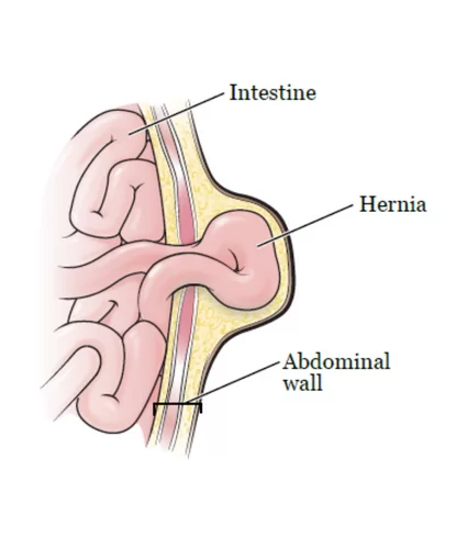 Causes of Hernia