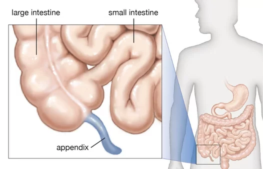 What is Appendix Surgery?