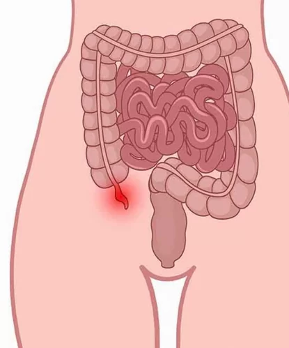 Causes of Appendix