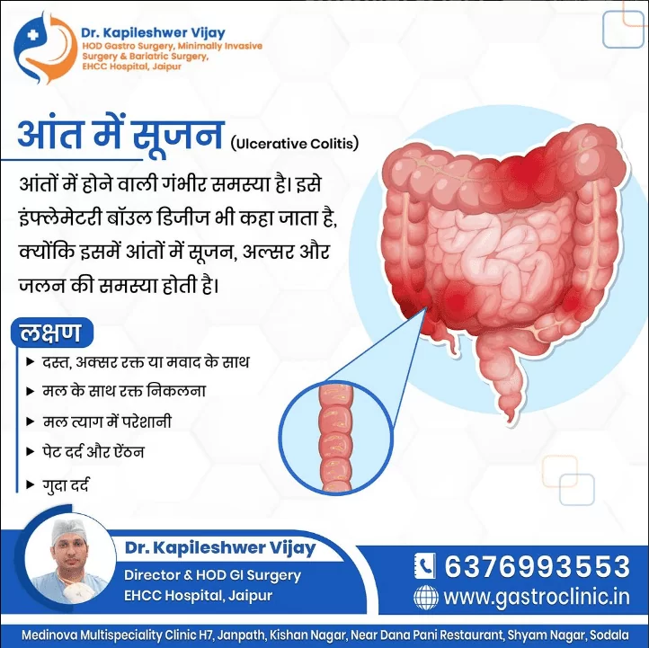 अल्सरेटिव कोलाइटिस