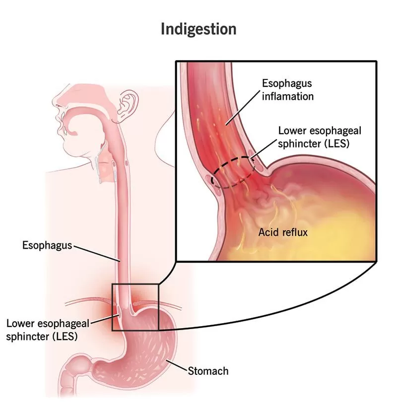 indigestion Treatment in JAipur