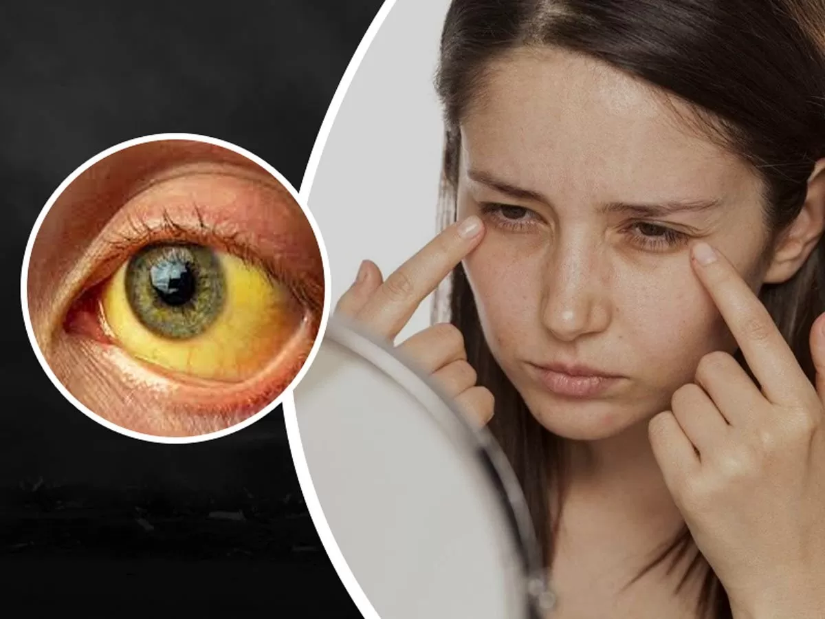 Symptoms Of Jaundice
