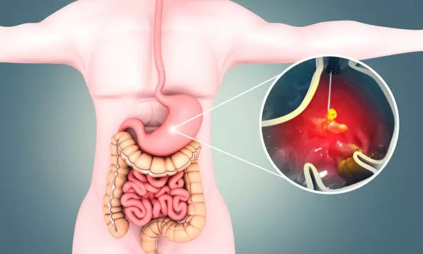 Ulcers Treatment in JAipur