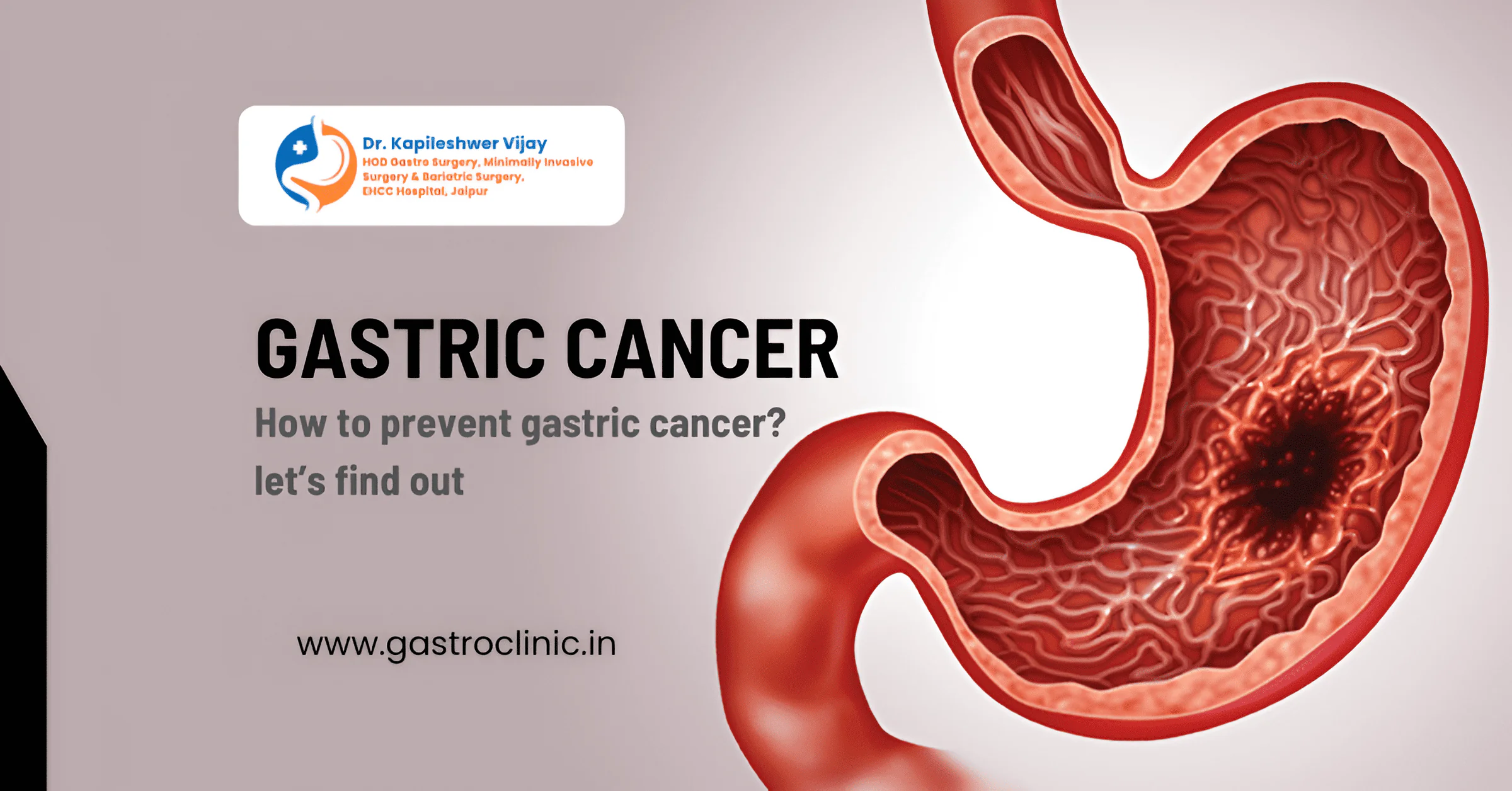 How to prevent gastric cancer? let’s find out