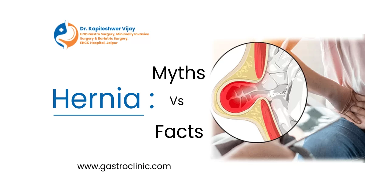 Hernia Surgery: Myths Vs Facts | What is Hernia Surgery